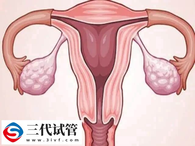 子宫疤痕憩室可不可以做试管婴儿(图1)