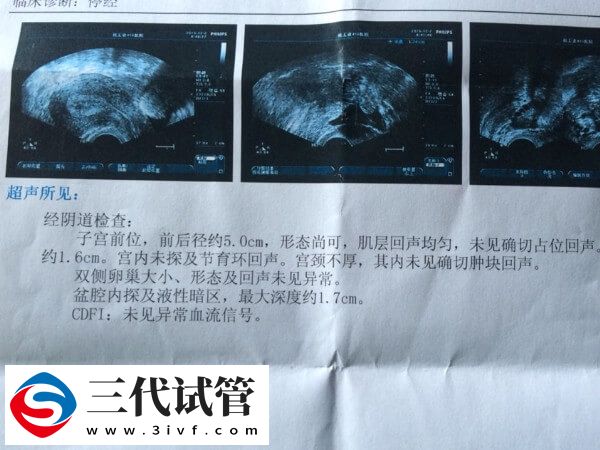 线性内膜后建议再等等，何时做试管婴儿移植要看个体情况(图2)