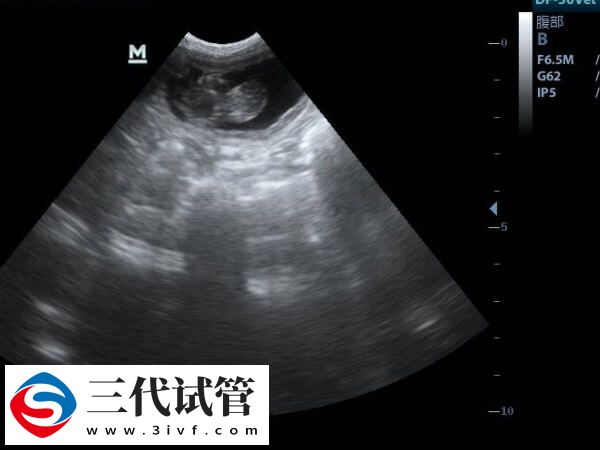 一文解读试管婴儿胎停时间与原因，早知道早预防(图1)