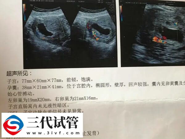 一文解读试管婴儿胎停时间与原因，早知道早预防(图2)