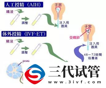1代、2代、3代试管，有什么区别？哪个适合你？(图3)