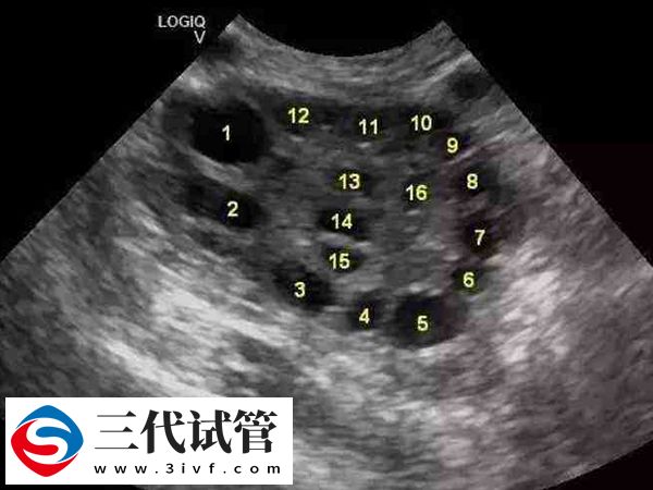 最佳取卵时间是什么时候(图1)