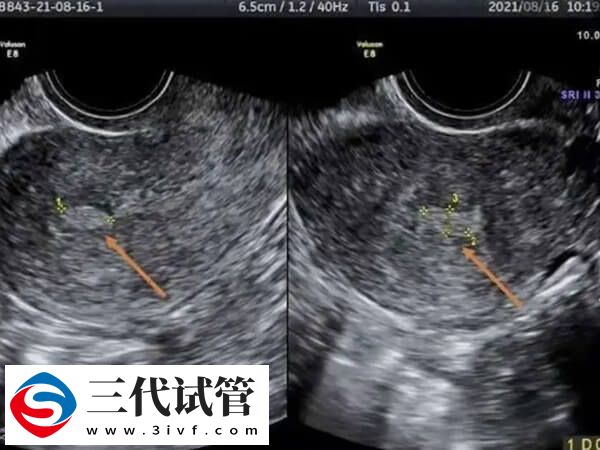 子宫内膜回声不均匀会影响做试管的移植成功率吗？(图1)