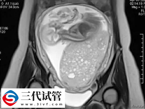 试管婴儿促排期间做b超的原因是什么(图1)